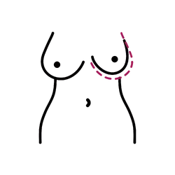 Breast Asymmetry Correction