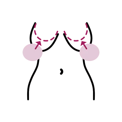 Breast Lift with Implants