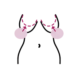 Breast Lift with Implants