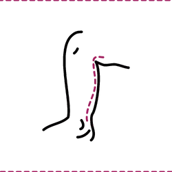 Calves & Ankles Liposuction