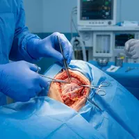 What Is a Deep Plane Facelift?