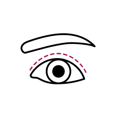 Double Eyelid Surgery