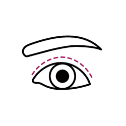 Double Eyelid Surgery