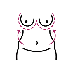 Fat Transfer Breast Augmentation