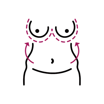 Fat Transfer Breast Augmentation