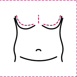 Gynecomastia Surgery