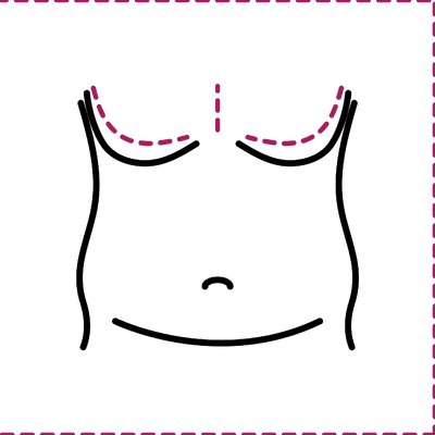 Gynecomastia Surgery