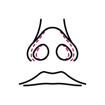 Alar Reduction in Thailand: Cost, Top Surgeons & Hospitals