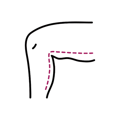 Thigh Lift in Thailand: Cost, Top Surgeons & Hospitals